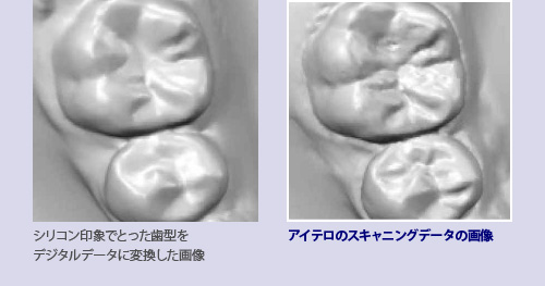 シリコン印象とインビザラインの比較