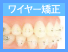 ワイヤー矯正