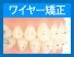 ワイヤー矯正