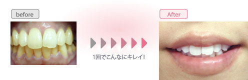 ホワイトニング