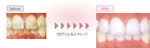 ホワイトニング