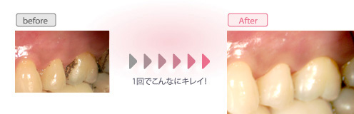 ホワイトニング